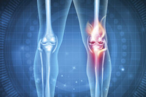 Read more about the article Homeopathy Treatment for Arthritis