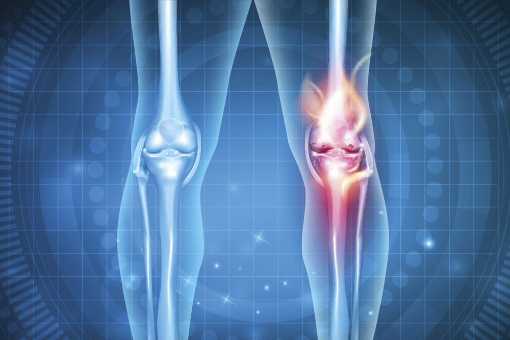 You are currently viewing Homeopathy Treatment for Arthritis